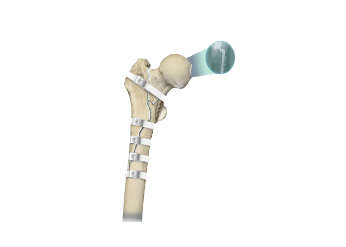 Cerclage Ortholox